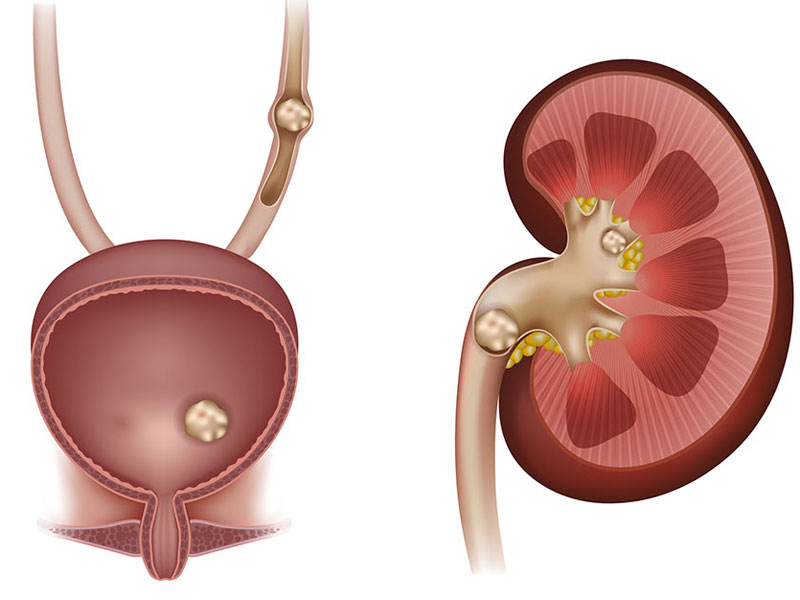 درمان سنگ کلیه