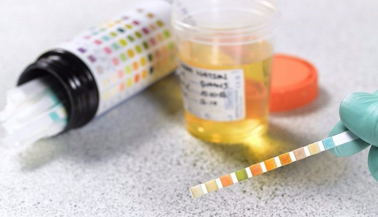 نشانه های دفع پروتئین از ادرار