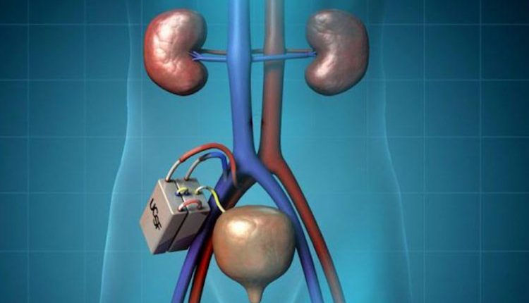 کلیه مصنوعی