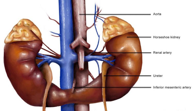 کلیه نعل اسبی