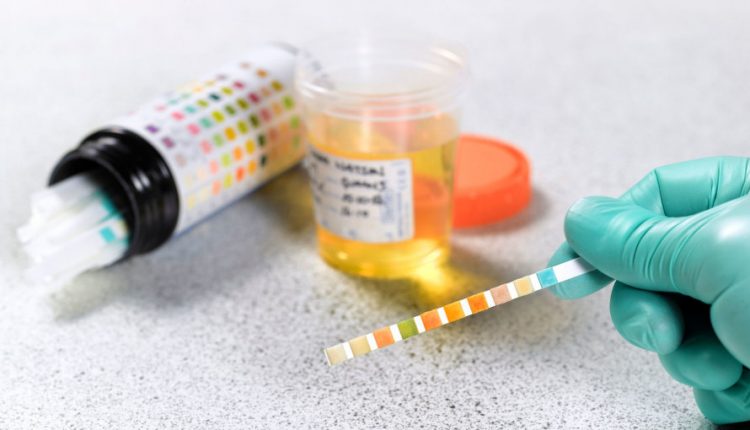 قند در ادرار